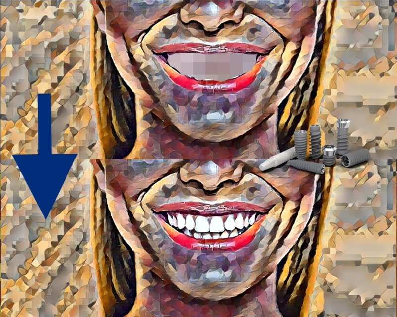 Restauration complète d’une mâchoire (implants dentaires Straumann + couronnes en zircone)