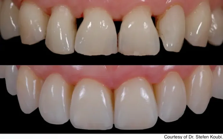 E.MAX Veneers: Tbilisi Dental Clinic Installation