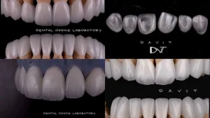 Veneers and Artificial Crowns
